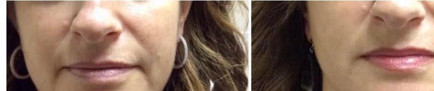 Before and after dermal filler treatment